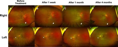 Consecutive Changes In The Fundus Findings Of The Patient With Vkh