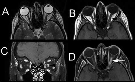 Incidental Optic Nerve Sheath Meningioma In A Year Old Female