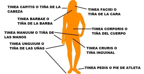 Tipos De TiÑas Dermatofitosis