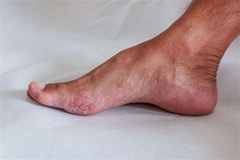 Fungal Infections - Wanneroo Podiatry