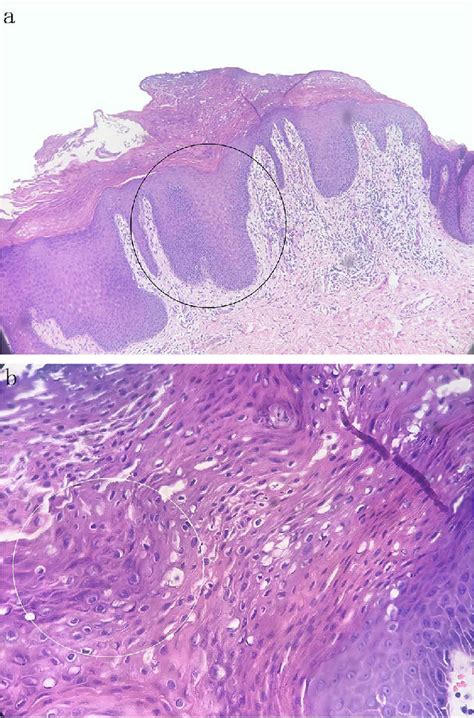 A And B The Horny Layer Showed Highly Compact Hyperkeratosis And