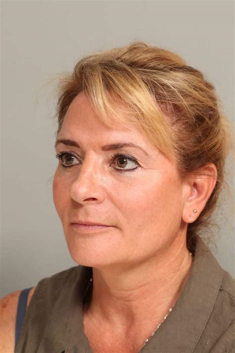 Endoscopic Browlift And Lower Blepharoplasty 8751