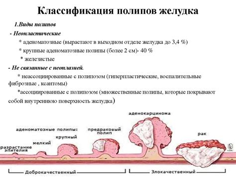 Полип желудка - презентация онлайн