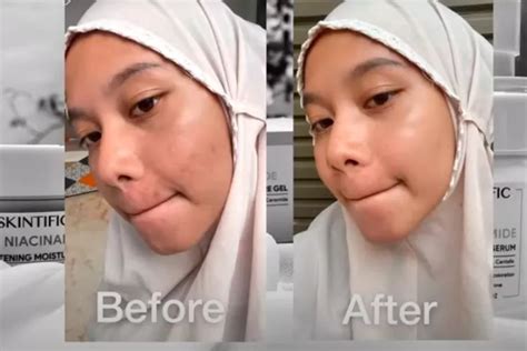 Review Pemakaian Skintific Brightening Set Selama 2 Minggu Sekarang Muka Aku Udah Kurang