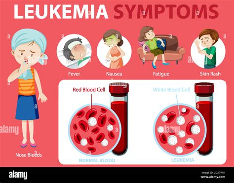 Leucemia S Ntomas Estilo De Dibujos Animados Infograf A Imagen Vector