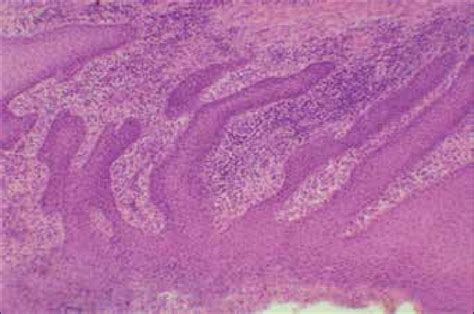 Marked Hyperplasia Of Multi Layered Squamous Epithelium In The Mucosa