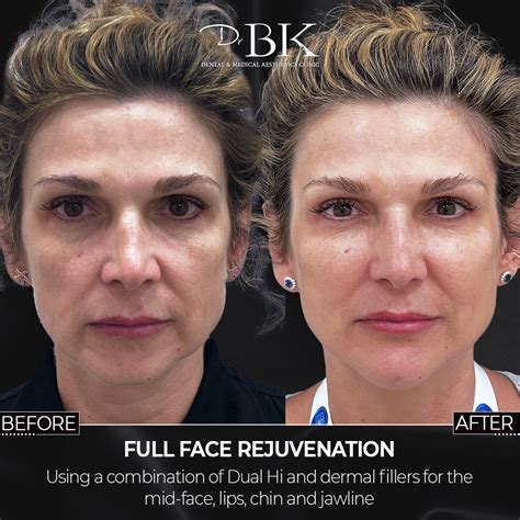 Non Surgical Full Face Aesthetic Treatments DrBK Clinics