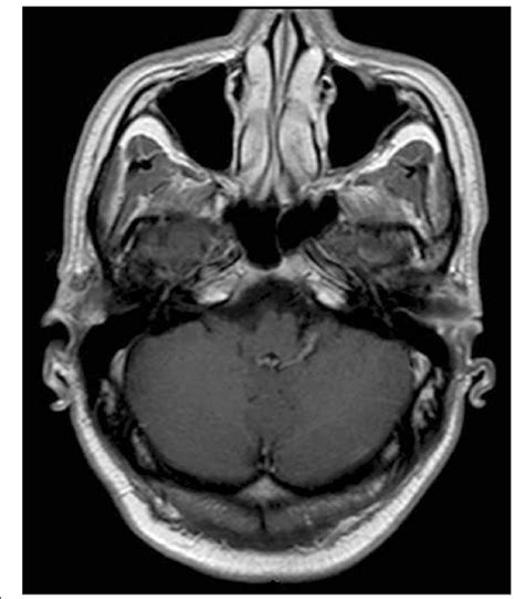 MRI Of The Central Nervous System 3 Months After Amoxicillin Treatment