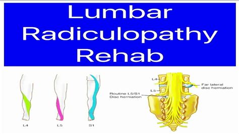 Lumbar Spine Rehab Radiculopathy Sciatica Lumbar Nerve Root