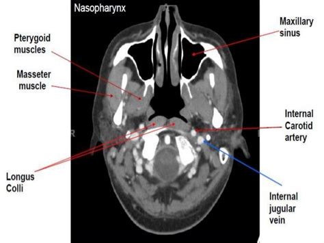 Nasopharynx Ct