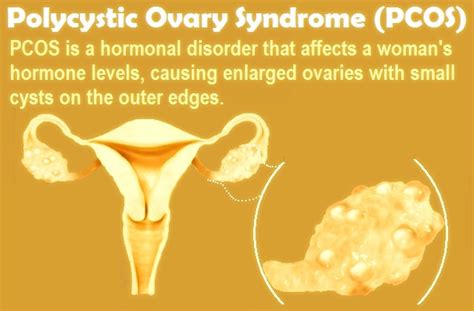 What Is Polycystic Ovary Syndrome Pcos Symptoms Causes And Treatment Of Pcos