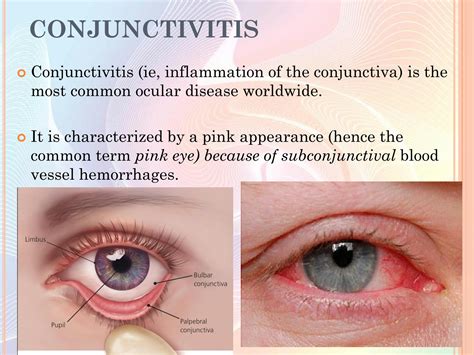 Solution Conjunctivitis Studypool