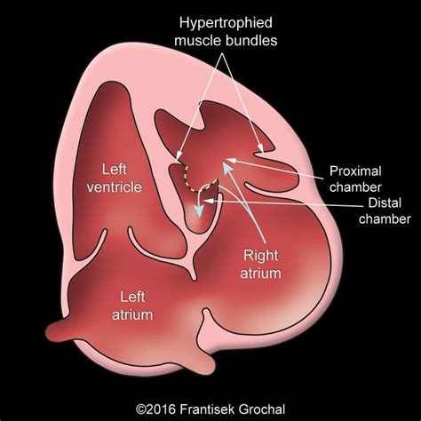 Pin De Nonas Arc Em Double Chamber Right Ventricle Dcrv