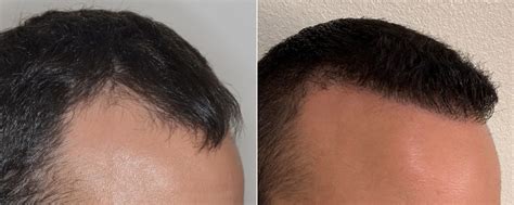 Hair Transplant Photos Miami Fl Patient 3496