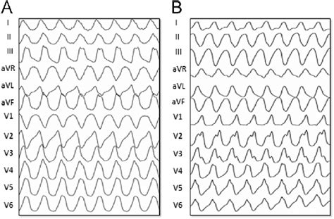 Representative Examples Of Ventricular Tachycardias Vts Induced