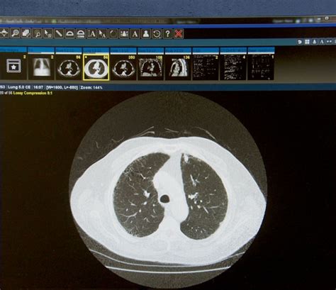 Lung Screening Mcleod Health Life Saving Lung Cancer Screenings