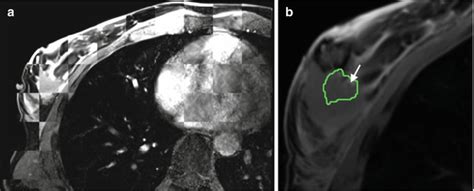 Magnetic Resonance Imaging Guided Breast Intervention And Surgery