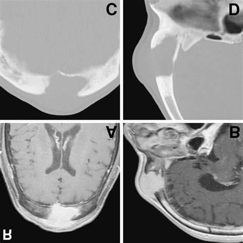 Preoperative Axial A And Sagittal B T 1 Weighted Magnetic Download Scientific Diagram