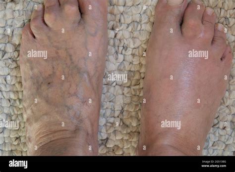 Human Webbed Feet Hi Res Stock Photography And Images Alamy