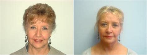 Facelift Before and After Pictures Fort Lauderdale, Coral Springs, FL