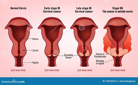 Image De Cancer Du Col De L Ut Rus Illustration De Vecteur