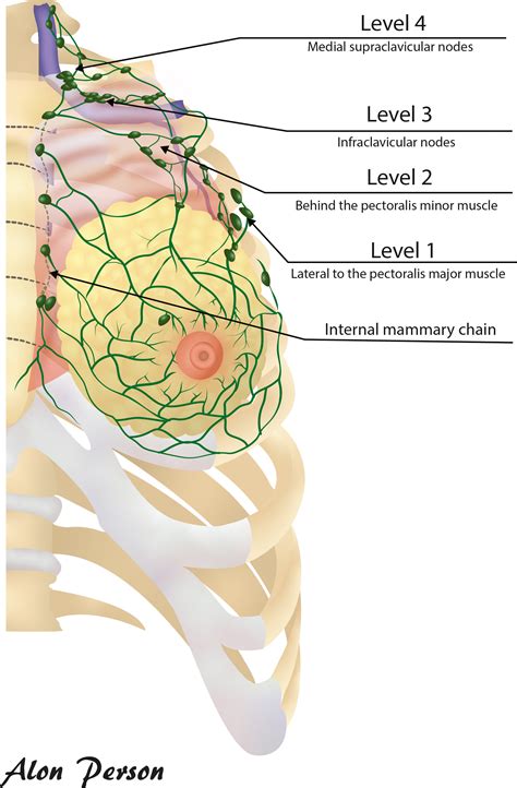 The Lucerne Toolbox 2 To Optimise Axillary Management For Early Breast