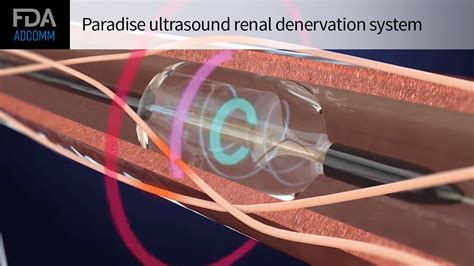 Fda Panel Backs Recors Renal Denervation System For Hypertension Medpage Today