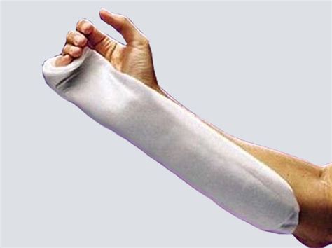 Ulnar Gutter Cast