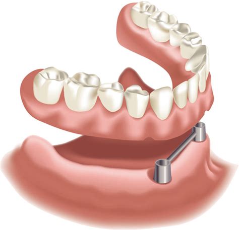 Stege Stegprothese Stegversorgung Auf Implantaten