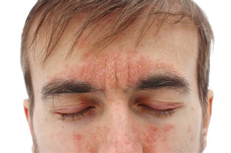 Psoriasis Around Eyes Symptoms Causes And Treatments