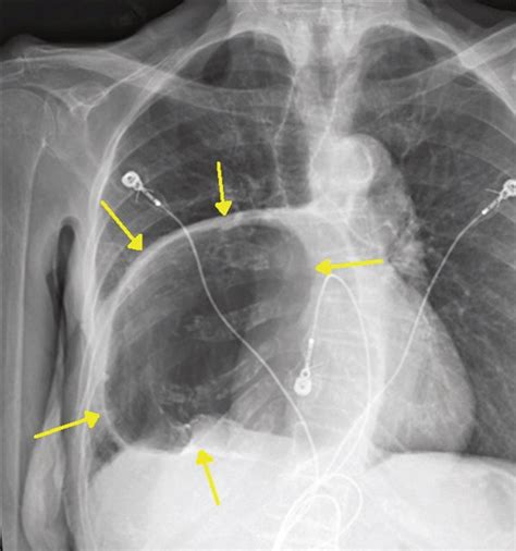 Upright Chest X Ray Showing Large Intrathoracic Hiatal Hernia Between Download Scientific