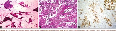 Figure 1 From Pitfalls In Diagnosing Specific Subtypes Of Carcinoma