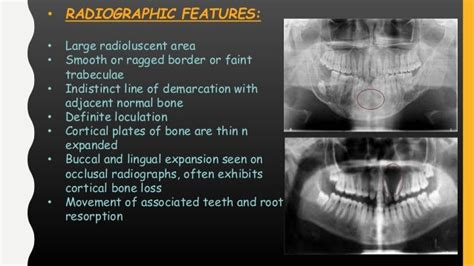 Peripheral and central giant cell granuloma