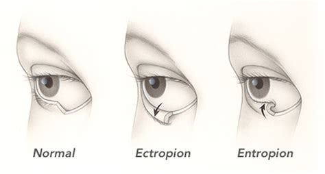 Entropion Causes, Symptoms, Diagnosis and Treatment | Natural Health News