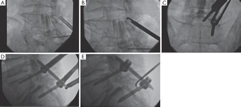 Figure 1 From Percutaneous Thoracolumbar Decompression Combined With