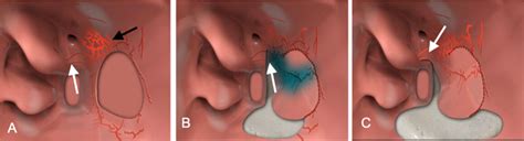 Posterior Septal Artery Flap For Endoscopic Repair Of Large Nasal