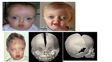 Crouzon Syndrome Face Baby Face Pediatrics