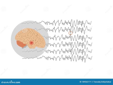 Focal Seizure Originating From Temporal Lobe Stock Vector