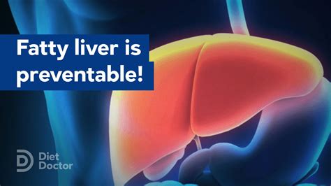 Good And Bad News For Fatty Liver — Diet Doctor