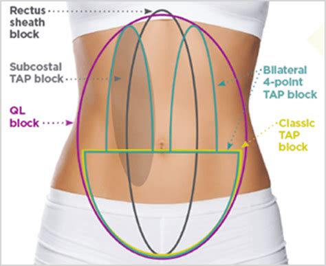 Anesthesia Field Block Tap