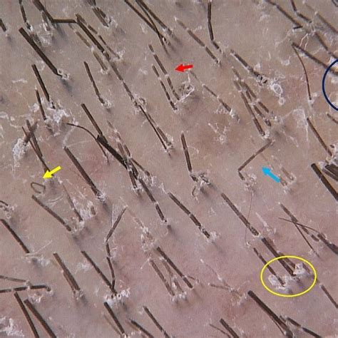 Trichoscopy Of Tinea Capitis With Polimorphic Pattern Including Bent Download Scientific