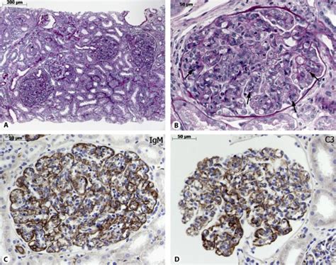 Renal Biopsy Findings In A Patient With A Cryoglobulin Induced Immune Download Scientific