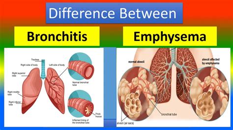 Chronic Bronchitis Vs Emphysema