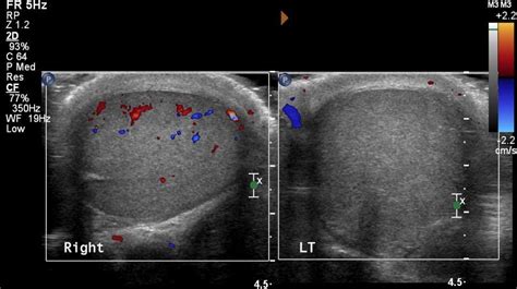 Testicular Torsion Pain Spermatic cord torsion; testicular torsion