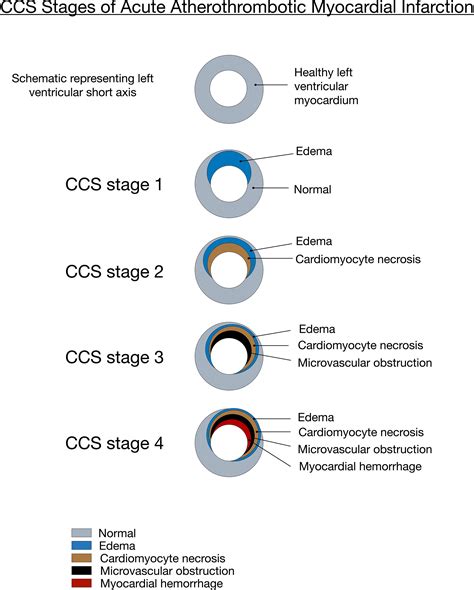 The Canadian Cardiovascular Society Classification Of Acute