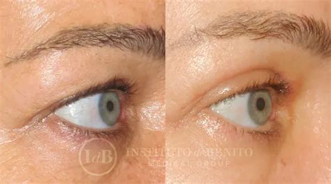 Blefaroplastia Precio Resultados Y Cirujanos Instituto De Benito