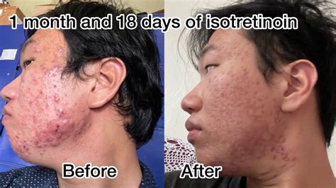 Month Before And After Isotretinoin Accutane Real Transformations