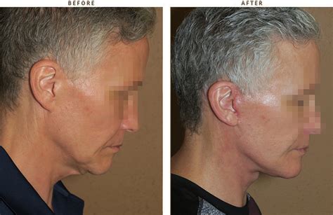 Liposuction of the neck – Before and After Pictures * | Dr Turowski - Plastic Surgery Chicago