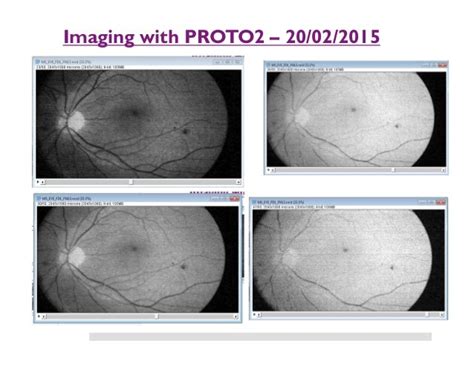 Retinalimager