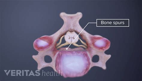 Cervical Foraminal Stenosis Spine Health